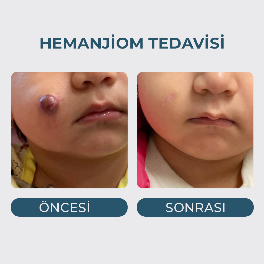 Hemanjiom Tedavisi