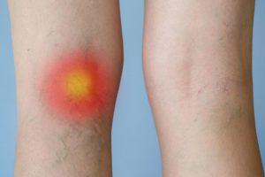 Varis Ülseri Tedavisi