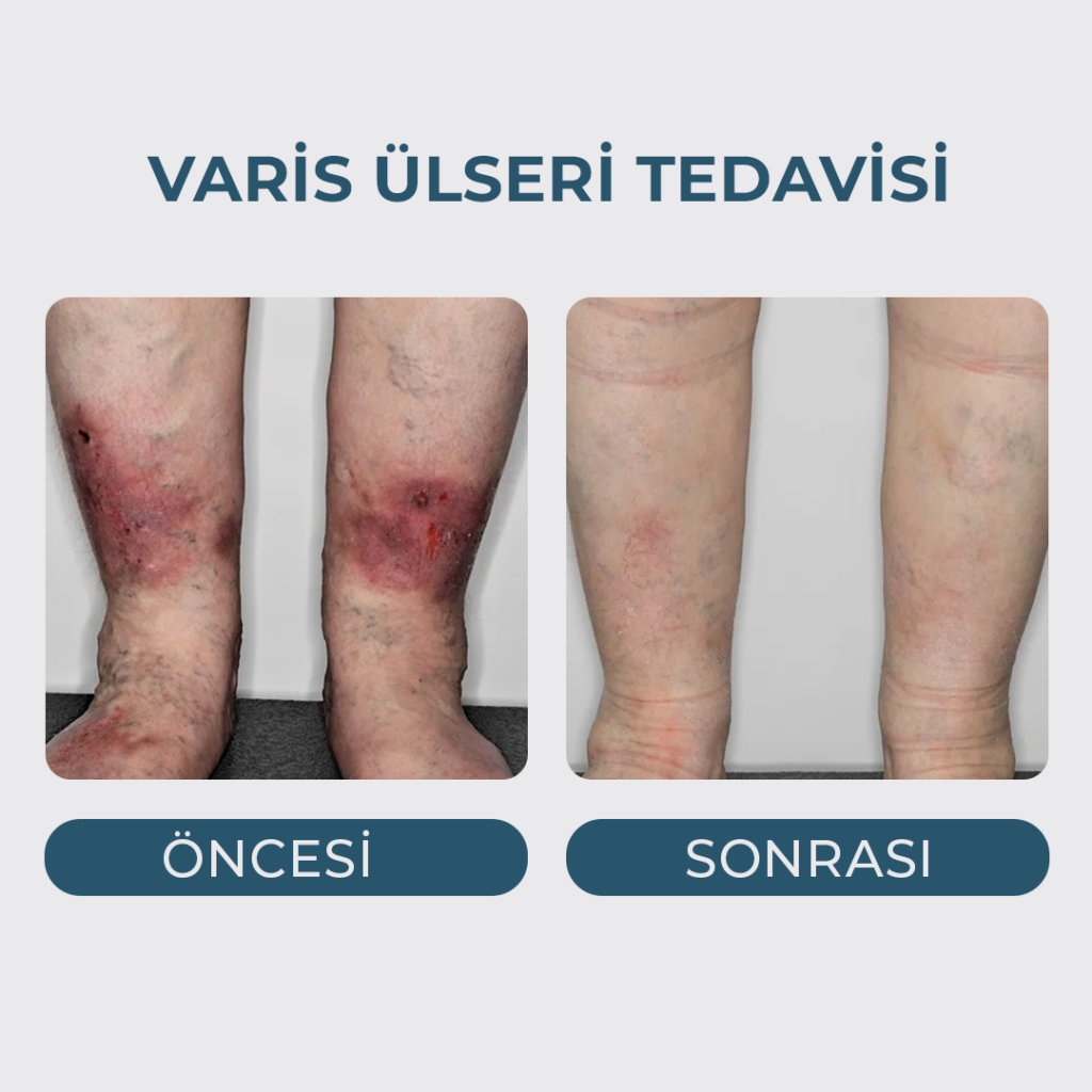 Varis Ülseri Tedavisi