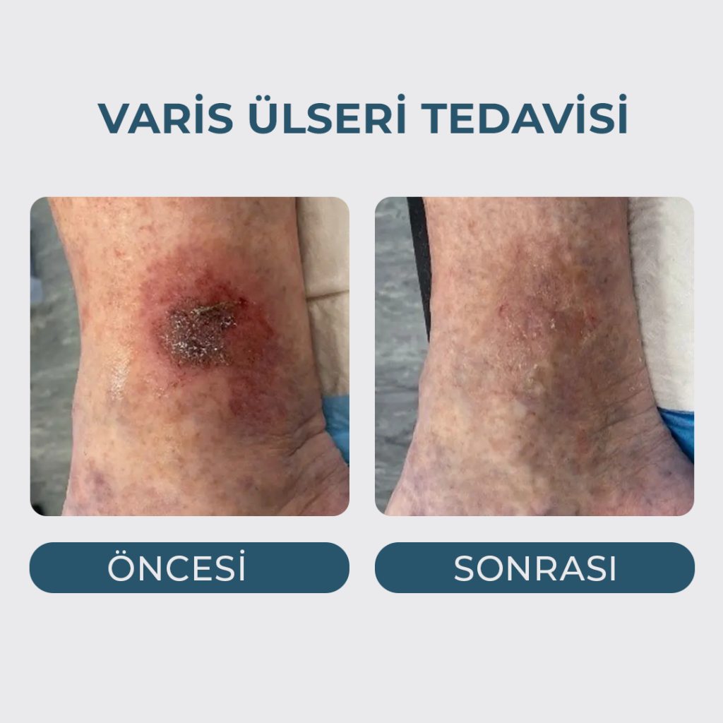 Varis Ülseri Tedavisi