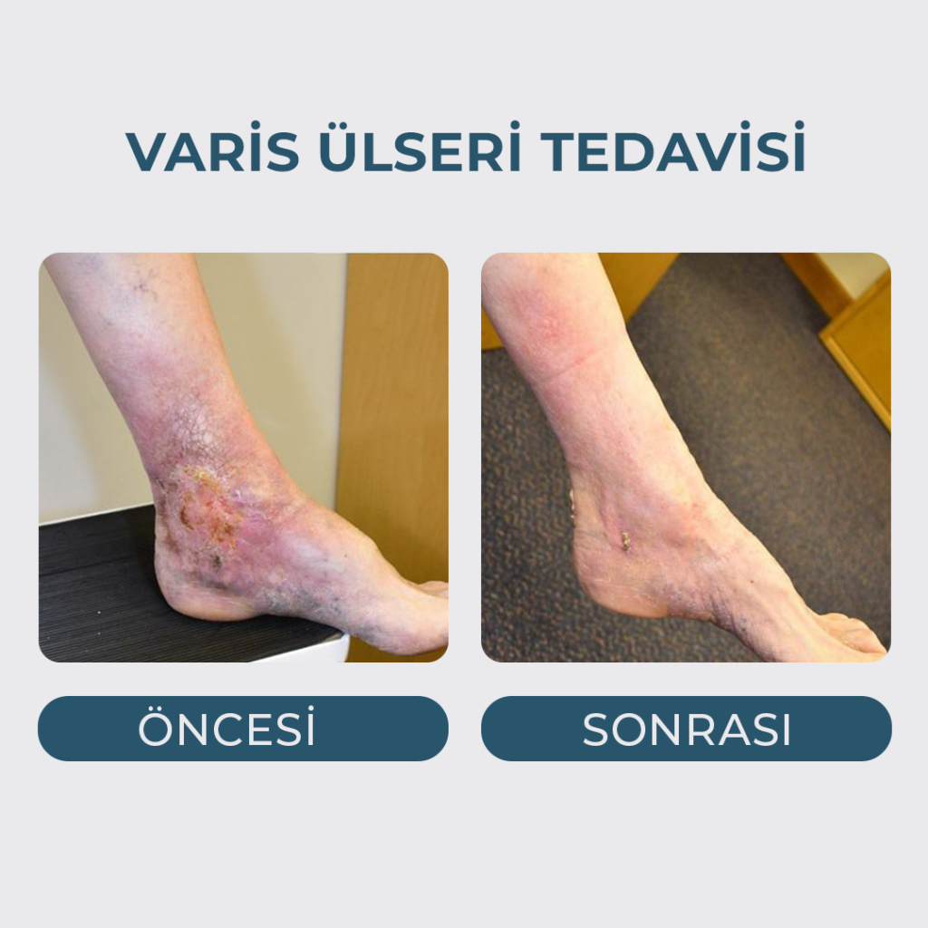 Varis Ülseri Tedavisi