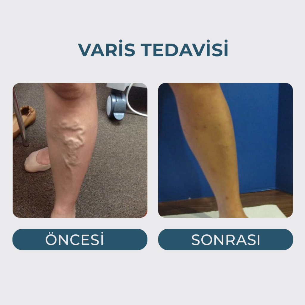 Varis Tedavisi