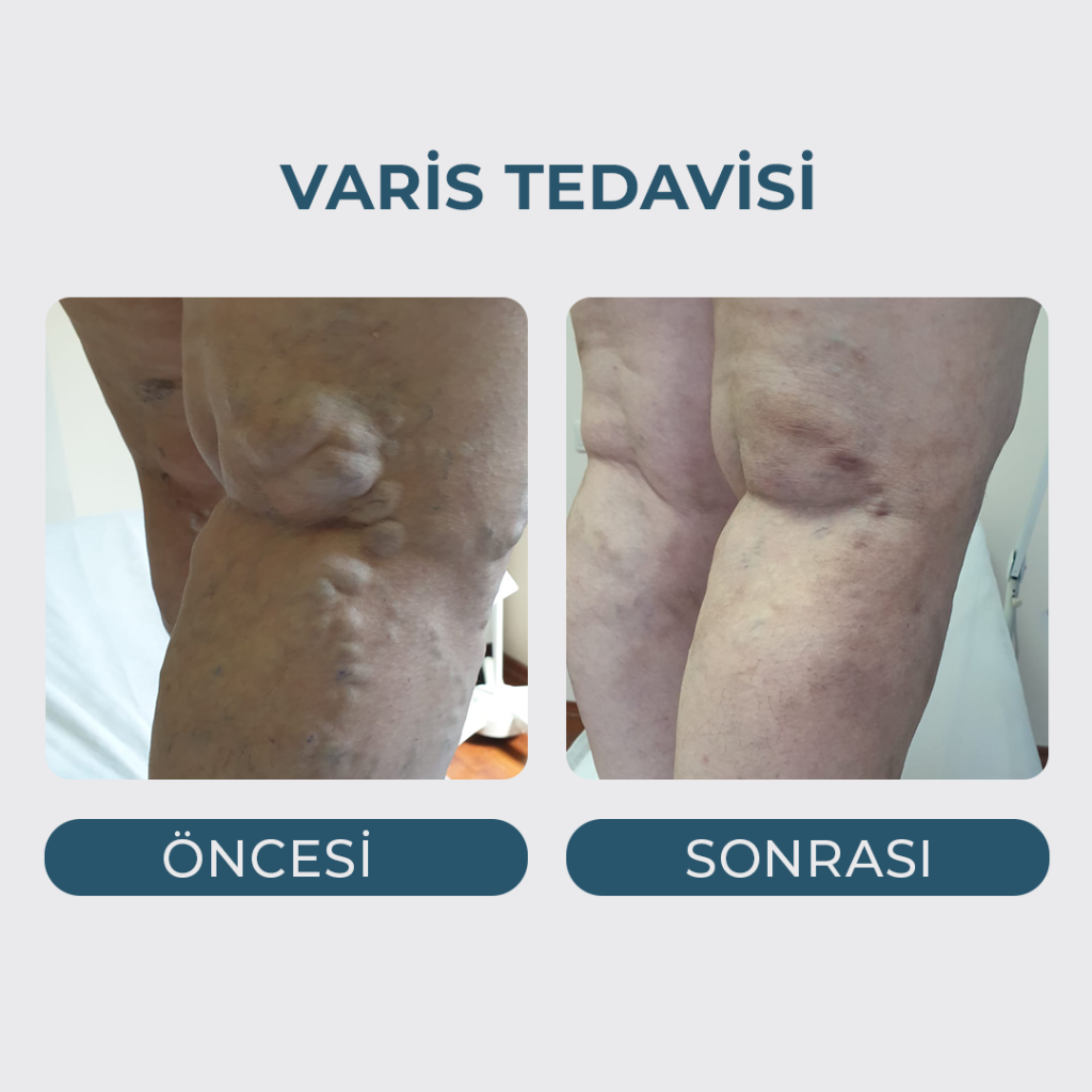 Varis Tedavisi