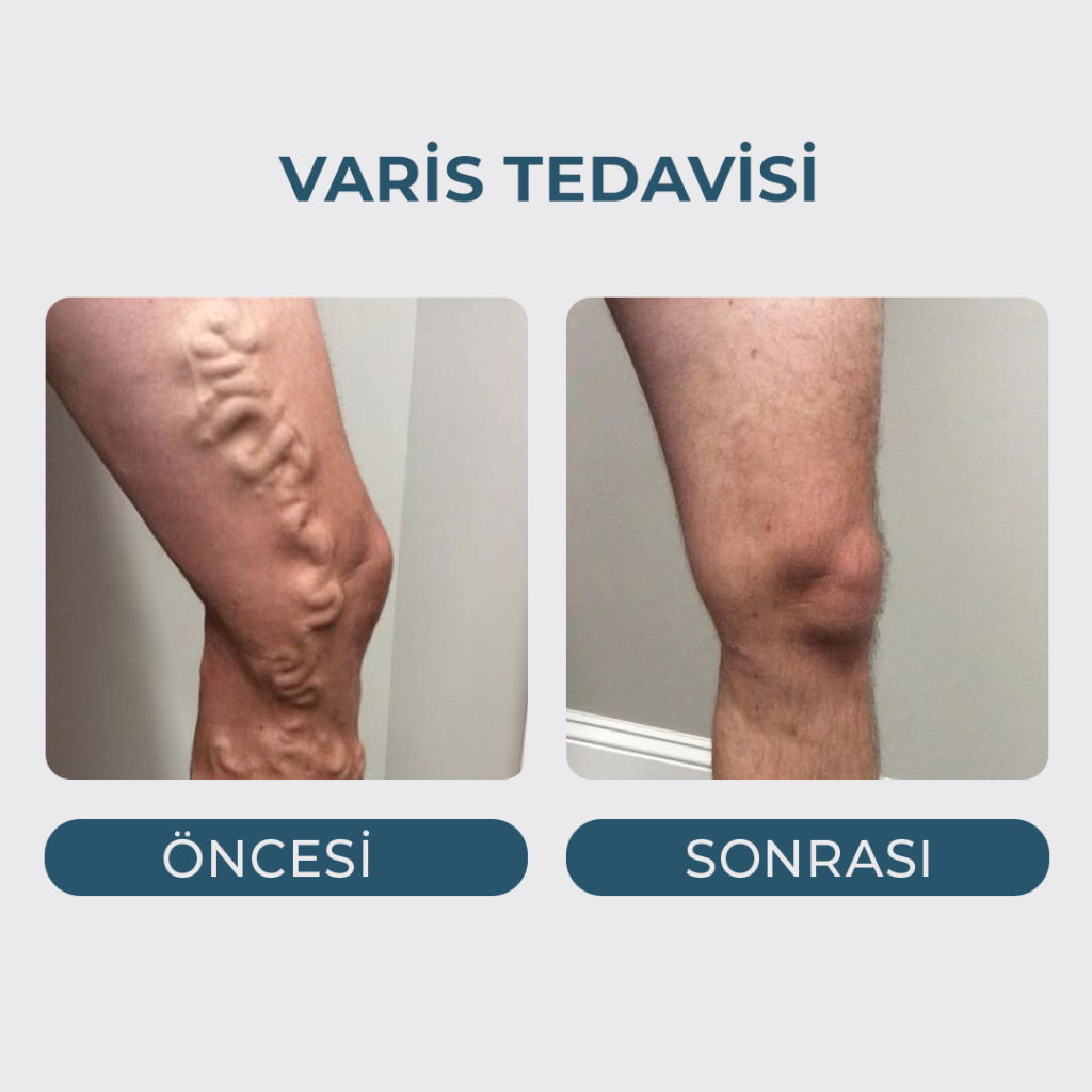 Varis Tedavisi