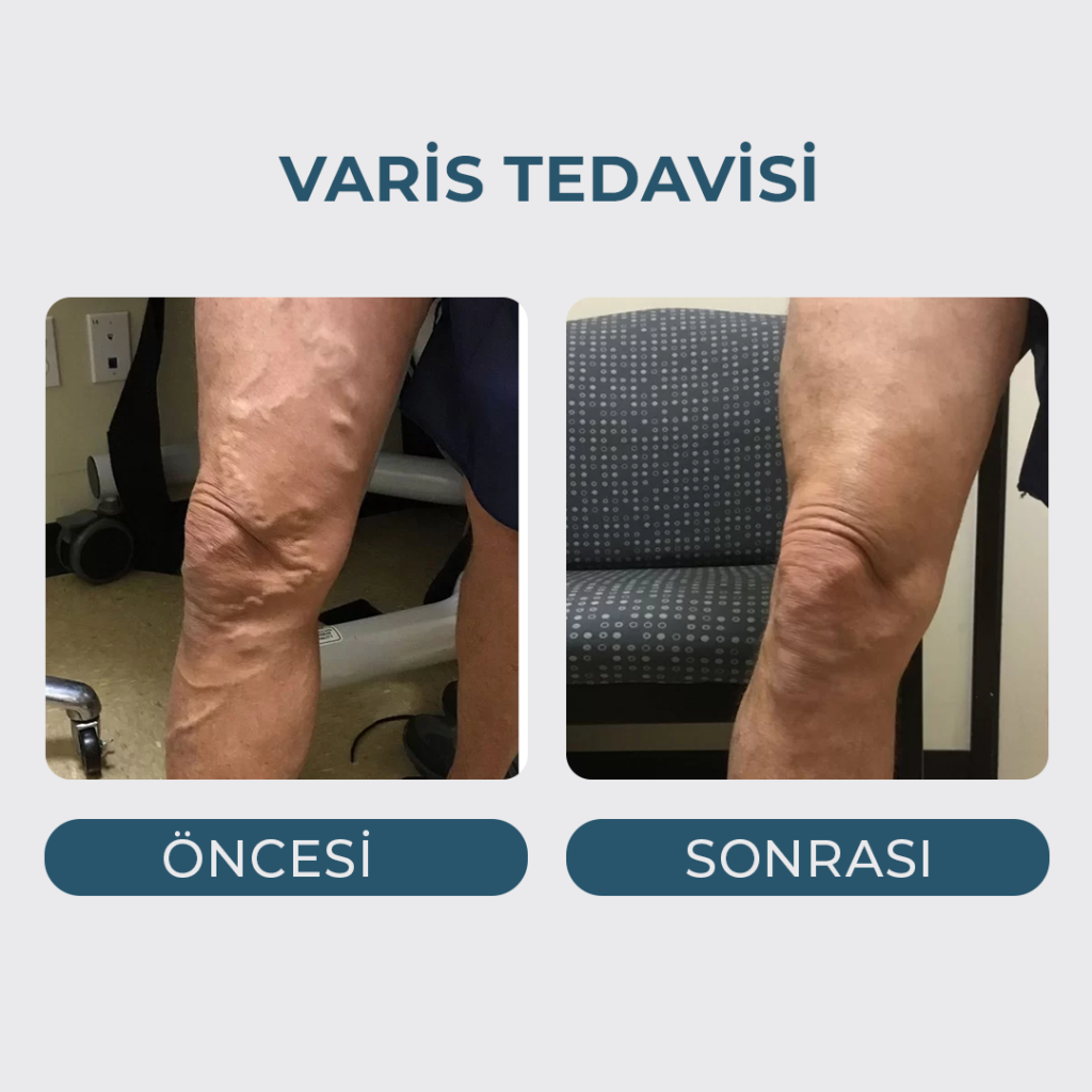 Varis Tedavisi